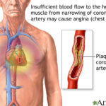 What Is Chronic Angina