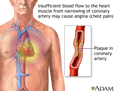 What Is Chronic Angina